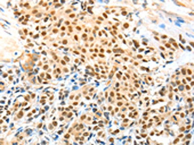 The image on the left is immunohistochemistry of paraffin-embedded Human esophagus cancer tissue using the antibody Antibody) at dilution 1/70, on the right is treated with fusion protein. (Original magnification: ×200)Rabbit anti-Human APPL1 Polyclonal Antibody