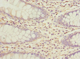Immunohistochemistry of paraffin-embedded human colon cancer using GALNT2 Antibody at dilution of 1:100Rabbit anti-Human GALNT2 Polyclonal Antibody