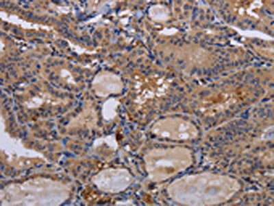 The image on the left is immunohistochemistry of paraffin-embedded Human thyroid cancer tissue using FADS1 Antibody(FADS1 Antibody) at dilution 1/60, on the right is treated with fusion protein. (Original magnification: ×200)Rabbit anti-Human FADS1 Polyclonal Antibody