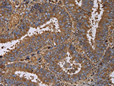 The image on the left is immunohistochemistry of paraffin-embedded Human colon cancer tissue using the antibody Antibody) at dilution 1/60, on the right is treated with fusion protein. (Original magnification: ×200)Rabbit anti-Human FADS1 Polyclonal Antibody
