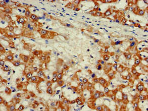 Immunohistochemistry of paraffin-embedded human liver cancer using the antibody at dilution of 1:100Rabbit anti-Human ZNF816 Polyclonal Antibody