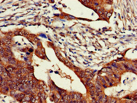 Immunohistochemistry of paraffin-embedded human colon cancer using ZNF816 Antibody at dilution of 1:100Rabbit anti-Human ZNF816 Polyclonal Antibody