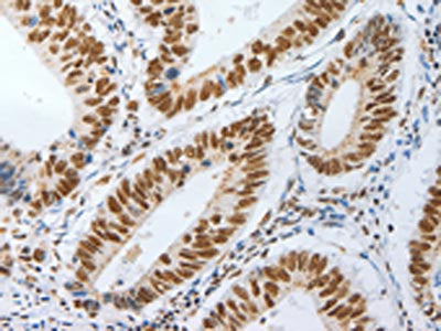 The image on the left is immunohistochemistry of paraffin-embedded Human colon cancer tissue using AKAP8L Antibody(AKAP8L Antibody) at dilution 1/25, on the right is treated with synthetic peptide. (Original magnification: ×200)Rabbit anti-Human AKAP8L Polyclonal Antibody
