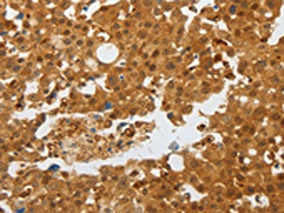 The image on the left is immunohistochemistry of paraffin-embedded Human breast cancer tissue using the antibody Antibody) at dilution 1/25, on the right is treated with synthetic peptide. (Original magnification: ×200)Rabbit anti-Human AKAP8L Polyclonal Antibody
