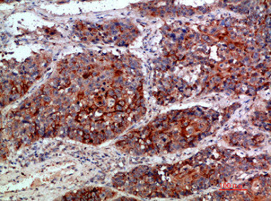 Immunohistochemical analysis of paraffin-embedded human-lung-cancer, antibody was diluted at 1:200