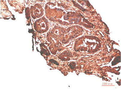 Immunohistochemical analysis of paraffin-embedded Human Prostate Carcinoma Tissue using ATM Rabbit pAb diluted at 1:500.