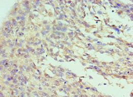Immunohistochemistry of paraffin-embedded human cervical cancer using ILF3 Antibody at dilution of 1:100Rabbit anti-Human ILF3 Polyclonal Antibody