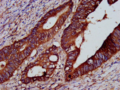 IHC image of the antibody diluted at 1:200 and staining in paraffin-embedded human colon cancer performed on a Leica BondTM system. After dewaxing and hydration, antigen retrieval was mediated by high pressure in a citrate buffer (pH 6.0). Section was blocked with 10% normal goat serum 30min at RT. Then primary antibody (1% BSA) was incubated at 4°C overnight. The primary is detected by a biotinylated secondary antibody and visualized using an HRP conjugated SP system.Rabbit anti-Human PTP4A2 Polyclonal Antibody