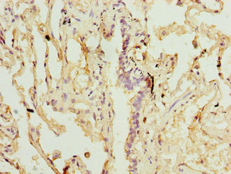 Immunohistochemistry of paraffin-embedded human lung tissue using SLA Antibody at dilution of 1:100Rabbit anti-Human SLA Polyclonal Antibody