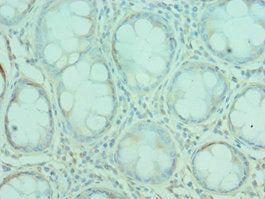 Immunohistochemistry of paraffin-embedded human colon cancer using G3BP1 Antibody at dilution of 1:100Rabbit anti-Human G3BP1 Polyclonal Antibody