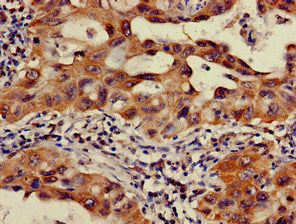 Immunohistochemistry of paraffin-embedded human lung cancer using OS9 Antibody at dilution of 1:100Rabbit anti-Human OS9 Polyclonal Antibody