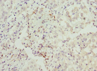 Immunohistochemistry of paraffin-embedded human lung cancer using BAAT Antibody at dilution of 1:100