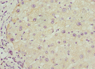 Immunohistochemistry of paraffin-embedded human liver cancer using BAAT Antibody at dilution of 1:100