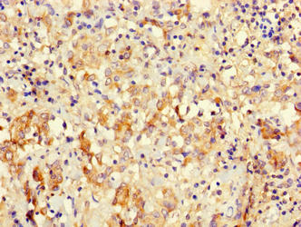 Immunohistochemistry of paraffin-embedded human lung tissue using MRPL58 Antibody at dilution of 1:100Rabbit anti-Human MRPL58 Polyclonal Antibody