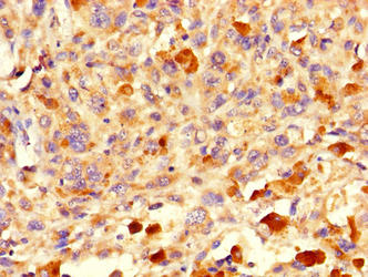 Immunohistochemistry of paraffin-embedded human melanoma using MRPL58 Antibody at dilution of 1:100Rabbit anti-Human MRPL58 Polyclonal Antibody