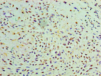 Immunohistochemistry of paraffin-embedded human breast cancer using GALE Antibody at dilution of 1:100Rabbit anti-Human GALE Polyclonal Antibody