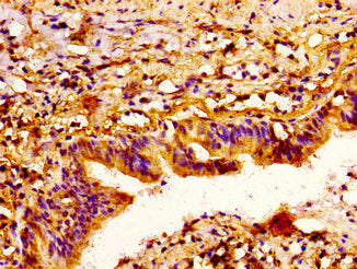 IHC image of SEMA3A Antibody diluted at 1:300 and staining in paraffin-embedded human lung cancer performed on a Leica BondTM system. After dewaxing and hydration, antigen retrieval was mediated by high pressure in a citrate buffer (pH 6.0). Section was blocked with 10% normal goat serum 30min at RT. Then primary antibody (1% BSA) was incubated at 4°C overnight. The primary is detected by a biotinylated secondary antibody and visualized using an HRP conjugated ABC system.Rabbit anti-Human SEMA3A Polyclonal Antibody