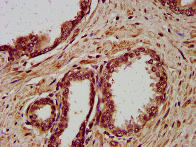 IHC image of the antibody diluted at 1:400 and staining in paraffin-embedded human prostate cancer performed on a Leica BondTM system. After dewaxing and hydration, antigen retrieval was mediated by high pressure in a citrate buffer (pH 6.0). Section was blocked with 10% normal goat serum 30min at RT. Then primary antibody (1% BSA) was incubated at 4°C overnight. The primary is detected by a biotinylated secondary antibody and visualized using an HRP conjugated SP system.Rabbit anti-Human DSC3 Polyclonal Antibody