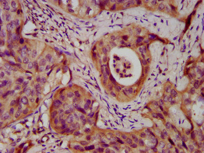 IHC image of DSC3 Antibody diluted at 1:400 and staining in paraffin-embedded human cervical cancer performed on a Leica BondTM system. After dewaxing and hydration, antigen retrieval was mediated by high pressure in a citrate buffer (pH 6.0). Section was blocked with 10% normal goat serum 30min at RT. Then primary antibody (1% BSA) was incubated at 4°C overnight. The primary is detected by a biotinylated secondary antibody and visualized using an HRP conjugated SP system.Rabbit anti-Human DSC3 Polyclonal Antibody