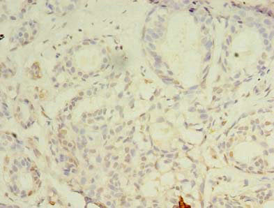 Immunohistochemistry of paraffin-embedded human breast cancer using CBX2 Antibody at dilution of 1:100