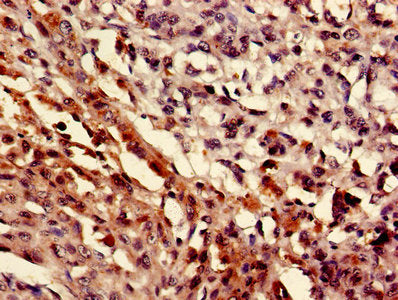 IHC image of MEF2D Antibody diluted at 1:400 and staining in paraffin-embedded human melanoma performed on a Leica BondTM system. After dewaxing and hydration, antigen retrieval was mediated by high pressure in a citrate buffer (pH 6.0). Section was blocked with 10% normal goat serum 30min at RT. Then primary antibody (1% BSA) was incubated at 4°C overnight. The primary is detected by a biotinylated secondary antibody and visualized using an HRP conjugated SP system.