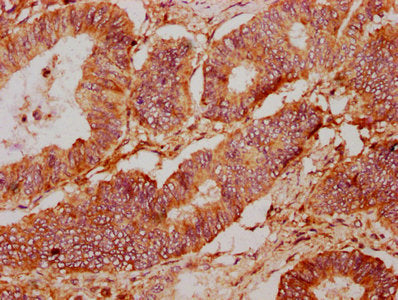 IHC image of PTPRK Antibody diluted at 1:400 and staining in paraffin-embedded human colon cancer performed on a Leica BondTM system. After dewaxing and hydration, antigen retrieval was mediated by high pressure in a citrate buffer (pH 6.0). Section was blocked with 10% normal goat serum 30min at RT. Then primary antibody (1% BSA) was incubated at 4°C overnight. The primary is detected by a biotinylated secondary antibody and visualized using an HRP conjugated SP system.Rabbit anti-Human PTPRK Polyclonal Antibody