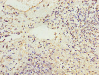 Immunohistochemistry of paraffin-embedded human cervical cancer using RBMS2 Antibody at dilution of 1:100Rabbit anti-Human RBMS2 Polyclonal Antibody