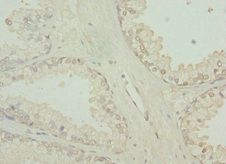 Immunohistochemistry of paraffin-embedded human prostate cancer using TBCE Antibody at dilution of 1:100Rabbit anti-Human TBCE Polyclonal Antibody