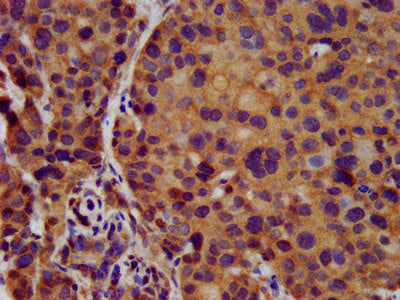 IHC image of KCNJ8 Antibody diluted at 1:500 and staining in paraffin-embedded human pancreatic cancer performed on a Leica BondTM system. After dewaxing and hydration, antigen retrieval was mediated by high pressure in a citrate buffer (pH 6.0). Section was blocked with 10% normal goat serum 30min at RT. Then primary antibody (1% BSA) was incubated at 4°C overnight. The primary is detected by a biotinylated secondary antibody and visualized using an HRP conjugated SP system.