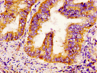 IHC image of the antibody diluted at 1:300 and staining in paraffin-embedded human endometrial cancer performed on a Leica BondTM system. After dewaxing and hydration, antigen retrieval was mediated by high pressure in a citrate buffer (pH 6.0). Section was blocked with 10% normal goat serum 30min at RT. Then primary antibody (1% BSA) was incubated at 4°C overnight. The primary is detected by a biotinylated secondary antibody and visualized using an HRP conjugated SP system.Rabbit anti-Human SCN9A Polyclonal Antibody