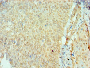 Immunohistochemistry of paraffin-embedded human cervical cancer using SSX2 Antibody at dilution of 1:100Rabbit anti-Human SSX2 Polyclonal Antibody