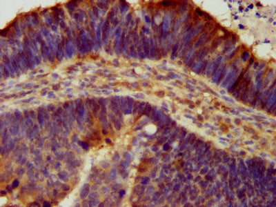 IHC image of the antibody diluted at 1:300 and staining in paraffin-embedded human ovarian cancer performed on a Leica BondTM system. After dewaxing and hydration, antigen retrieval was mediated by high pressure in a citrate buffer (pH 6.0). Section was blocked with 10% normal goat serum 30min at RT. Then primary antibody (1% BSA) was incubated at 4°C overnight. The primary is detected by a biotinylated secondary antibody and visualized using an HRP conjugated SP system.