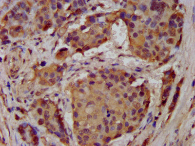 IHC image of ASIC2 Antibody diluted at 1:300 and staining in paraffin-embedded human pancreatic cancer performed on a Leica BondTM system. After dewaxing and hydration, antigen retrieval was mediated by high pressure in a citrate buffer (pH 6.0). Section was blocked with 10% normal goat serum 30min at RT. Then primary antibody (1% BSA) was incubated at 4°C overnight. The primary is detected by a biotinylated secondary antibody and visualized using an HRP conjugated SP system.Rabbit anti-Human ASIC2 Polyclonal Antibody