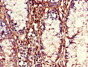 Immunohistochemistry of paraffin-embedded human colon cancer using CDC37 Antibody at dilution of 1:100Rabbit anti-Human CDC37 Polyclonal Antibody