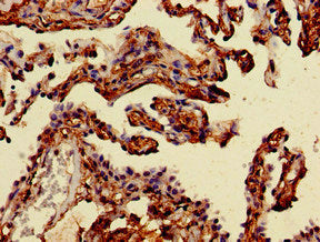 Immunohistochemistry of paraffin-embedded human lung cancer using MAN2A1 Antibody at dilution of 1:100