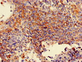 Immunohistochemistry of paraffin-embedded human cervical cancer using MAN2A1 Antibody at dilution of 1:100