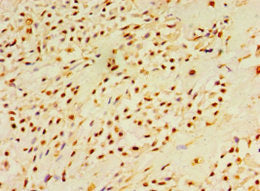 Immunohistochemistry of paraffin-embedded human breast cancer using DUSP7 Antibody at dilution of 1:100Rabbit anti-Human DUSP7 Polyclonal Antibody