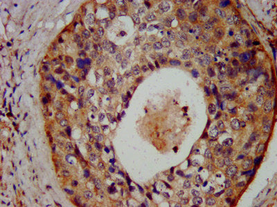 IHC image of PTPN13 Antibody diluted at 1:300 and staining in paraffin-embedded human cervical cancer performed on a Leica BondTM system. After dewaxing and hydration, antigen retrieval was mediated by high pressure in a citrate buffer (pH 6.0). Section was blocked with 10% normal goat serum 30min at RT. Then primary antibody (1% BSA) was incubated at 4°C overnight. The primary is detected by a biotinylated secondary antibody and visualized using an HRP conjugated SP system.Rabbit anti-Human PTPN13 Polyclonal Antibody