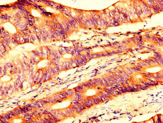 IHC image of USP4 Antibody diluted at 1:500 and staining in paraffin-embedded human colon cancer performed on a Leica BondTM system. After dewaxing and hydration, antigen retrieval was mediated by high pressure in a citrate buffer (pH 6.0). Section was blocked with 10% normal goat serum 30min at RT. Then primary antibody (1% BSA) was incubated at 4°C overnight. The primary is detected by a biotinylated secondary antibody and visualized using an HRP conjugated SP system.Rabbit anti-Human USP4 Polyclonal Antibody