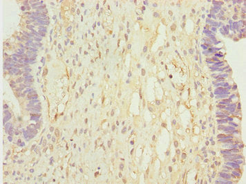 Immunohistochemistry of paraffin-embedded human ovarian cancer using CALCOCO2 Antibody at dilution of 1:100
