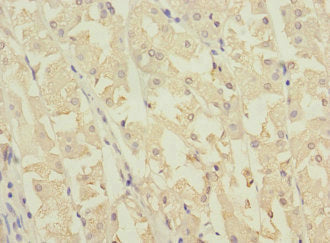 Immunohistochemistry of paraffin-embedded human gastric cancer using NME3 Antibody at dilution of 1:100Rabbit anti-Human NME3 Polyclonal Antibody