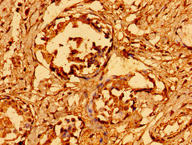 Immunohistochemistry of paraffin-embedded human breast cancer using GAB1 Antibody at dilution of 1:100Rabbit anti-Human GAB1 Polyclonal Antibody