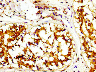 IHC image of CAPRIN1 Antibody diluted at 1:200 and staining in paraffin-embedded human breast cancer performed on a Leica BondTM system. After dewaxing and hydration, antigen retrieval was mediated by high pressure in a citrate buffer (pH 6.0). Section was blocked with 10% normal goat serum 30min at RT. Then primary antibody (1% BSA) was incubated at 4°C overnight. The primary is detected by a biotinylated secondary antibody and visualized using an HRP conjugated SP system.