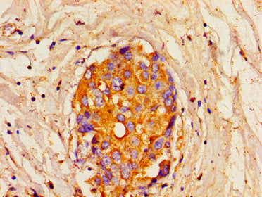 Immunohistochemistry of paraffin-embedded human breast cancer using the antibody at dilution of 1:100