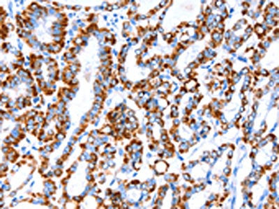 The image on the left is immunohistochemistry of paraffin-embedded Human thyroid cancer tissue using the antibody Antibody) at dilution 1/20, on the right is treated with fusion protein. (Original magnification: ×200)