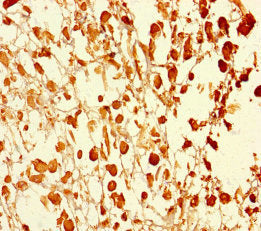 Immunohistochemistry of paraffin-embedded human melanoma using UBXN2B Antibody at dilution of 1:100Rabbit anti-Human UBXN2B Polyclonal Antibody