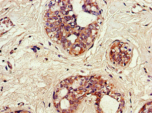 Immunohistochemistry of paraffin-embedded human breast cancer using SNX17 Antibody at dilution of 1:100Rabbit anti-Human SNX17 Polyclonal Antibody