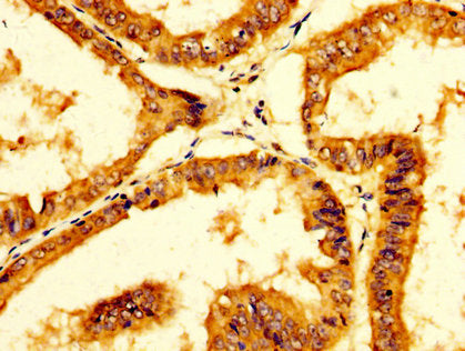 IHC image of PPA1 Antibody diluted at 1:200 and staining in paraffin-embedded human endometrial cancer performed on a Leica BondTM system. After dewaxing and hydration, antigen retrieval was mediated by high pressure in a citrate buffer (pH 6.0). Section was blocked with 10% normal goat serum 30min at RT. Then primary antibody (1% BSA) was incubated at 4°C overnight. The primary is detected by a biotinylated secondary antibody and visualized using an HRP conjugated SP system.Rabbit anti-Human PPA1 Polyclonal Antibody