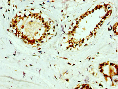 IHC image of RAB35 Antibody diluted at 1:400 and staining in paraffin-embedded human breast cancer performed on a Leica BondTM system. After dewaxing and hydration, antigen retrieval was mediated by high pressure in a citrate buffer (pH 6.0). Section was blocked with 10% normal goat serum 30min at RT. Then primary antibody (1% BSA) was incubated at 4°C overnight. The primary is detected by a biotinylated secondary antibody and visualized using an HRP conjugated SP system.Rabbit anti-Human RAB35 Polyclonal Antibody