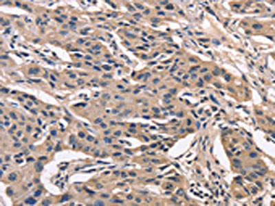 The image on the left is immunohistochemistry of paraffin-embedded Human lung cancer tissue using PEBP1 Antibody(PEBP1 Antibody) at dilution 1/40, on the right is treated with fusion protein. (Original magnification: ×200)Rabbit anti-Human PEBP1 Polyclonal Antibody